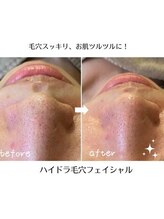 かれん/ハイドラ毛穴コース