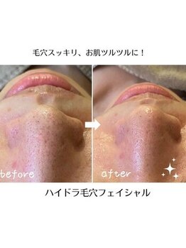 かれん/ハイドラ毛穴コース