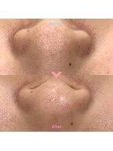 ルポアン(Repos an)/ハイドラフェイシャル