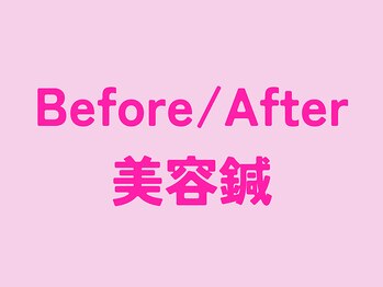 美容鍼＆首肩こり骨盤整体サロン ひふね/美容鍼 Before/After