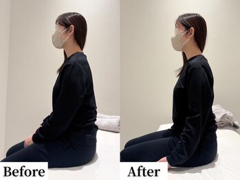 ソレア(Solea)/首こり・肩こり・姿勢改善1回目