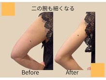 ヨサパーク ココロ 町田店(YOSA PARK COCORO)/二の腕も痩せる　Beforeafter