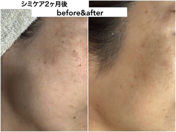 ディアメ(Diame)/お肌シミケアコース