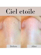 シエルエトワレ/毛穴エクストラクション