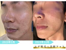 トレース/ヒゲ脱毛＋フォトの効果