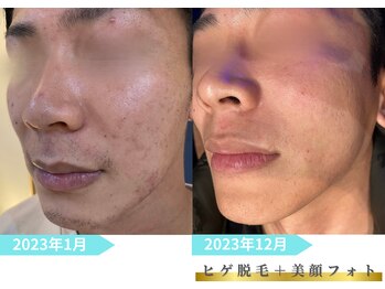 トレース/ヒゲ脱毛＋フォトの効果