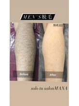 ソルツーサロン マナ(MANA)/メンズ脱毛