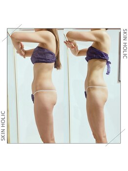 スキンホリック 恵比寿駅前店(SKIN HOLIC)/全身☆痩身ビフォア＆アフター★