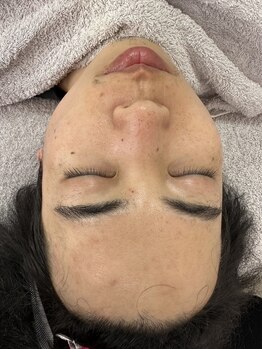 リコリス(Lycoris)/毛穴洗浄