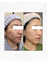 アルル 甲賀(ARuru)/皮膚科に行ってもダメだった