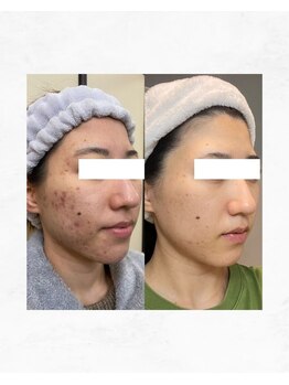 アルル 甲賀(ARuru)/皮膚科に行ってもダメだった