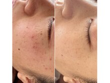 イロドリ(irodori)/エクソソームハーブピーリング♪