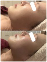 エルール トータルビューティ(Aileure total beauty)/術後DTケア　フェイスライン