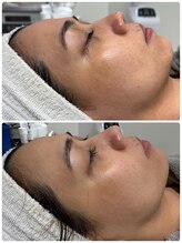 ウェイビーズ エステ(wavy's.esthetic)/【ビフォーアフター】くすみ改善