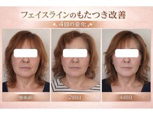 りんぱサロン まり/4回目まで変化