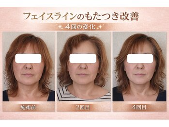 りんぱサロン まり/4回目まで変化