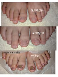 深爪矯正