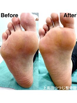 上高田つつじ整体院/ガサガサの角質もお任せください
