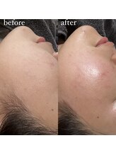 アイリー(IRIE)/肌が綺麗になるフェイスワックス