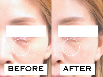 ビハリスト 池袋東口/目元のゴルゴ線が改善！