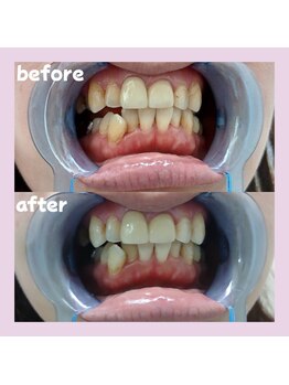 パレ 大阪十三店(Palet)/1回の照射のbefore/after