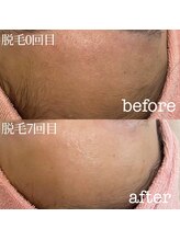 テテアテテ(tete a tete)/うぶ毛ケア＝顔脱毛で肌変わる！