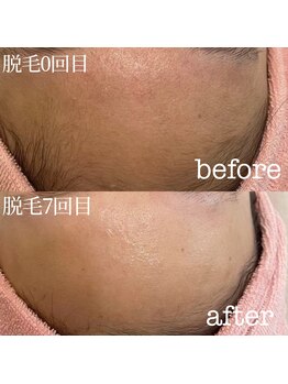 テテアテテ(tete a tete)/うぶ毛ケア＝顔脱毛で肌変わる！