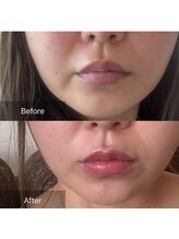 キレナル(KIRENAL)/レモンボトル