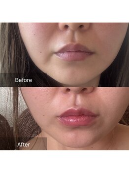 キレナル(KIRENAL)/レモンボトル