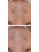 ココ(COCO)/鼻の黒ずみお任せください！