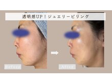 ユヌランコント 岐阜店(Une rencontre)/ジュエリーピーリング