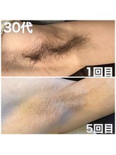 メンズ脱毛 ウィッシュ(Wish)/ワキ脱毛　5回目　