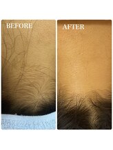 ジェシカ 荻窪店/荻窪/うなじ脱毛3