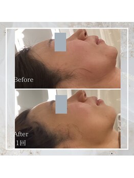 プレミドール(PREMIDOLL)/Before After/小顔矯正