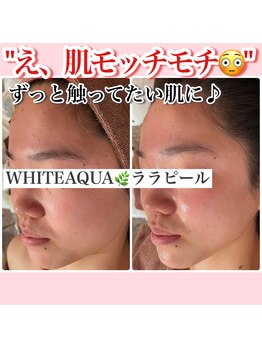ホワイトアクア 新宿本店(WHITE AQUA)/ララピール/東京/新宿/毛穴