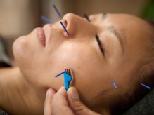 鍼灸整体ラクーナ/施術の様子２