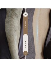 ジュゴン(Dugong)/足の全体脱毛（Before＆After）