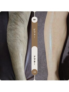 ジュゴン(Dugong)/足の全体脱毛（Before＆After）