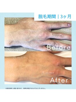 メンズクリア 高知帯屋町店/【メンズクリア】お客様の施術例
