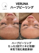 ココ 2号店(CoCo)/にきび改善ハーブピーリング