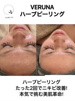 ココ 2号店(CoCo)/にきび改善ハーブピーリング