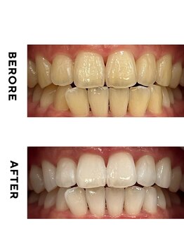 ホワイトニング ショップ 豊見城店/ホワイトニング