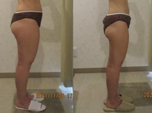 プロラボスパ 新宿店/20代前半　症例写真