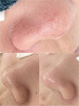 ニュートラル(neutral)/毛穴エクストラクションプロ大分