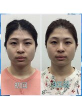 一時的な小顔ではなく、より理想の小顔になるように!また小顔をキープできる施術メンテナンスを大切に
