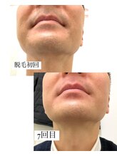 リル(Lil)/ヒゲ脱毛7回目！