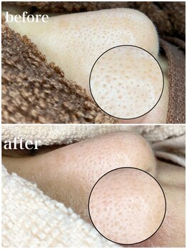 毛穴専科/角質で詰まった毛穴を空っぽに♪