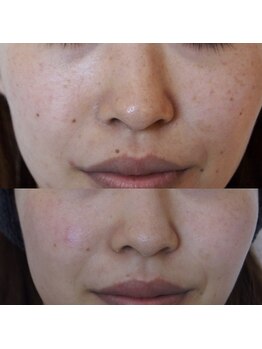 トラット エステアンドアイズ(tratto)/30代　お客様症例写真