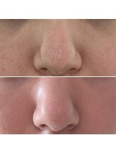 ハーナウ ハウ(hanau hou)/ハーブピーリング効果