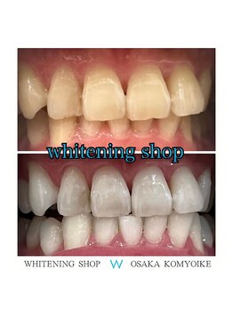 ホワイトニングショップ 光明池店/【ビフォーアフター】5回